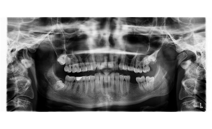 Dental X-ray machine detection model